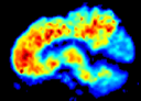 PET image of brain using PIB