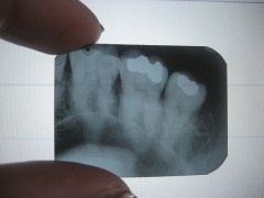 dental x-ray