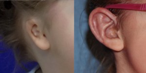 Microtia ear before and after surgery (Courtesy of Lewin)