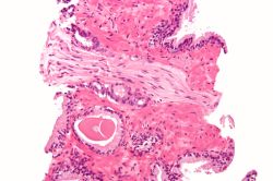 prostatic_adenocarcinoma_with_perineural_invasion